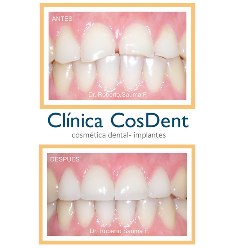 Antes y después de dientes desgastados restaurados con carillas y coronas, paciente de CosDent