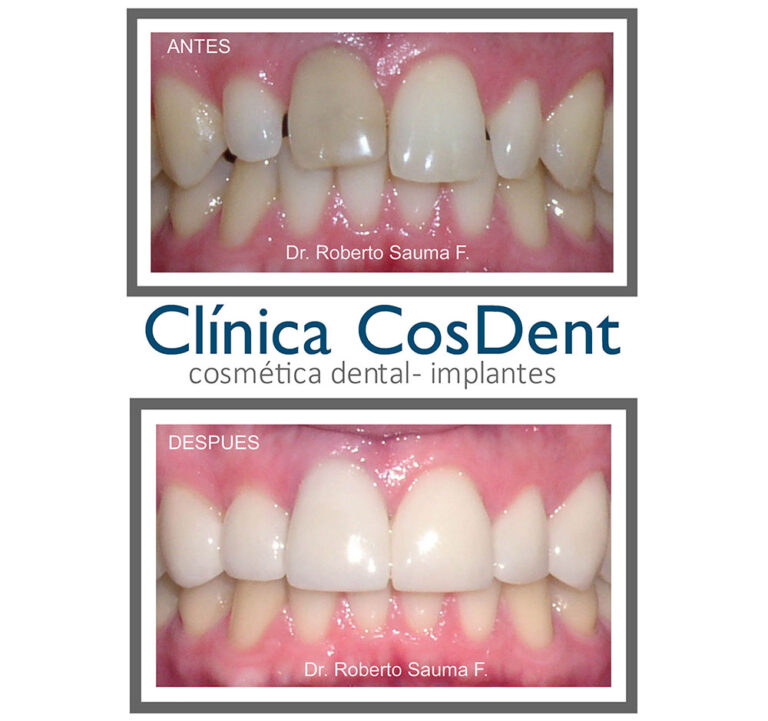 Antes y después de carillas de porcelana: corrección del color de los dientes, paciente de CosDent