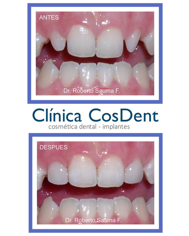 Antes y después de carillas de porcelana: corrección de la forma de los dientes, paciente de CosDent