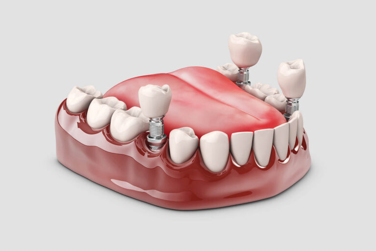 Implantes Dentales Costa Rica
