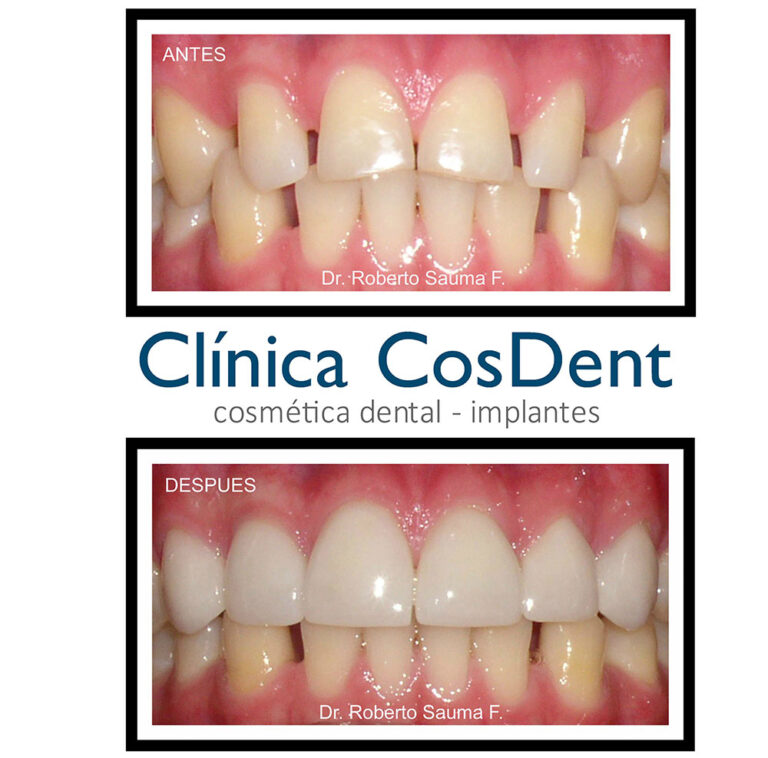 Antes y después de carillas de porcelana: cierre de espacios entre dientes, paciente de CosDent
