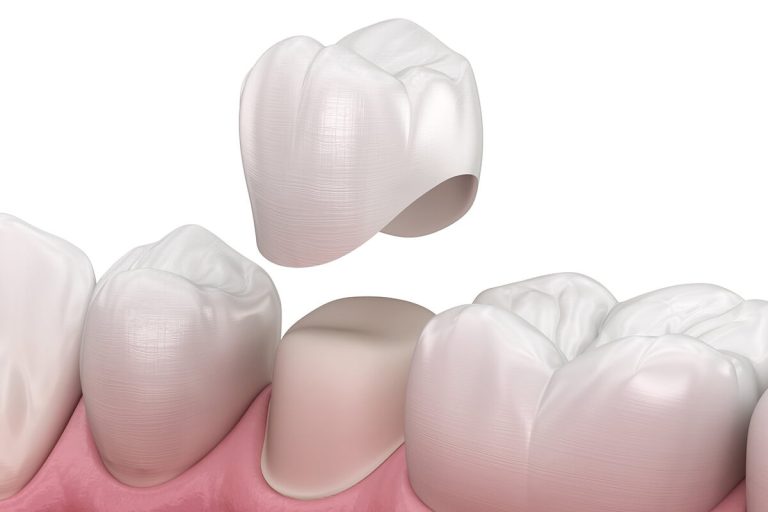 Corona dental de zirconio fabricada en el laboratorio de Clínica CosDent
