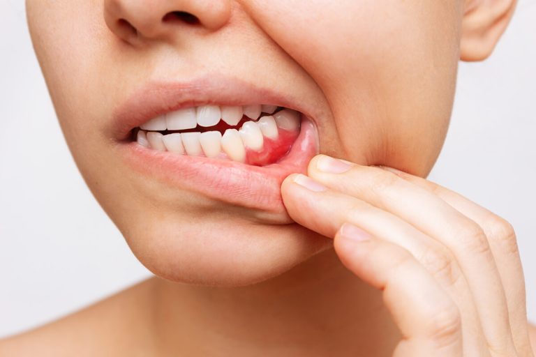 Sangrado de Encías - Gingivitis